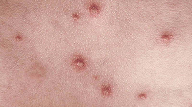 varicoza i tromboflebita fac varicoza balerina